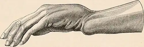 Dorsal displacement of carpal bones seen in dorsally angulated distal radius fracture, creating a fork-like appearance