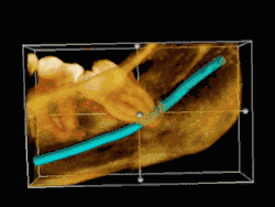 Impacted third molar