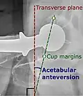 Acetabular anteversion.[105] This parameter is calculated on a lateral radiograph as the angle between the transverse plane and a line going through the (anterior and posterior) margins of the acetabular cup.[105]