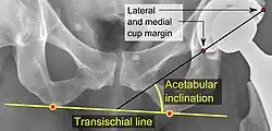 Acetabular inclination.[104] This parameter is calculated on an anteroposterior radiograph as the angle between a line through the lateral and medial margins of the acetabular cup and the transischial line which is tangential to the inferior margins of the ischium bones.[104]