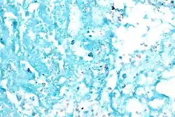 Acid fast bacilli, Ziehl–Neelsen stain.
