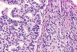 Adenosquamous carcinoma, with glandular features at left and squamous features at right