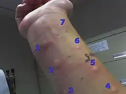 Forearm showing hives at numbered locations. Each wheal indicates an allergy to the substance placed there.