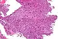Intermediate magnification micrograph of an aneurysmal bone cyst