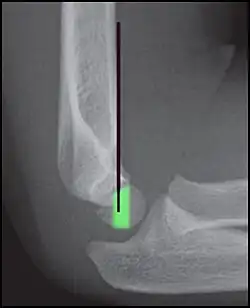 Anterior humeral line (black line), with normal area passed on the capitulum of the humerus colored in green in a 4-year-old child.[11]