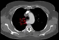 Aberrant subclavian artery at axial CT-scan. (1) trachea, (2) esophagus, (3) aberrant subclavian artery.