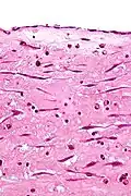 Atrial myxoma covered by endothelium. H&E stain.
