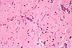 Atrial myxoma. H&E stain.