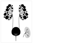 Autosomal dominant polycystic kidney disease