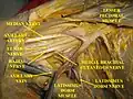 The outermost (distal) part of the brachial plexus shown from a dissected cadaveric specimen