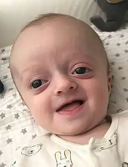 Baby with Crouzon Syndrome