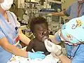 Baby with encephalocele.