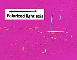 Uric acid crystals in polarized light, showing negative birefringence, with yellow color when aligned parallel to the axis of the red compensator, and blue when aligned perpendicularly to it.[58]