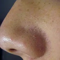 Sebaceous filaments are commonly mistaken for blackheads. However, they are completely harmless and are a natural part of the skin for people with oily skin.[5]