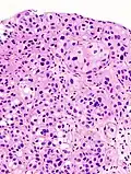 Histopathology of urothelial carcinoma of the urinary bladder, showing a nested pattern of invasion. Transurethral biopsy. H&E stain