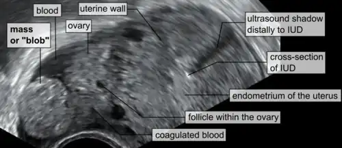 A "blob sign", which consists of the ectopic pregnancy. The ovary is distinguished from it by having follicles, whereof one is visible in the field. This patient had an intrauterine device (IUD) with progestogen, whose cross-section is visible in the field, leaving an ultrasound shadow distally to it.