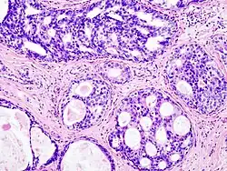 Ductal carcinoma in situ (DCIS) in breast tissue, cell nuclei (blue-purple), extracellular material (pink)