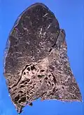 Bronchiectasis primarily in the middle lobe of the right lung