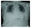 Acute interstitial pneumonia showing a marked reduction in lung capacity