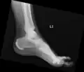 Ectopic calcification at Achilles tendon insertion and new bone formation in calcaneal spur in diffuse idiopathic skeletal hyperostosis (DISH)