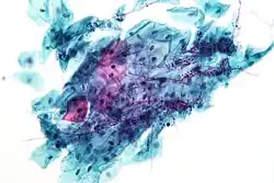 Candida organisms on a pap test.
