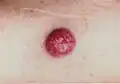 Merkel cell carcinoma[7]