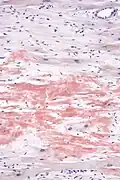 Micrograph showing amyloid deposition (red fluffy material) in the heart (cardiac amyloidosis). Congo red stain.