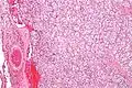 Micrograph of a carotid body tumor