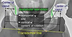 Center of rotation: The horizontal center of rotation is calculated as the distance between the acetabular teardrop and the center of the head (or caput) of the prosthesis and/or the native femoral head on the contralateral side.[104] The vertical center of rotation instead uses the transischial line for reference.[104] The parameter should be equal on both sides.[104]