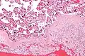 Micrograph of chronic deciduitis. H&E stain.