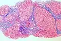 Trichrome stain, showing cirrhosis as a nodular texture surrounded by fibrosis (wherein collagen is stained blue)