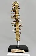 Scoliosis
