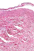 Confluent Epidermal Necrosis, low mag