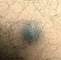 Dermatofibroma[6]