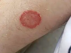 Image 23Tinea corporis (from Fungal infection)