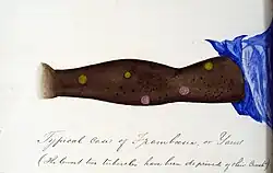 Outstretched arm with multiple raised pink lesions on its inner side