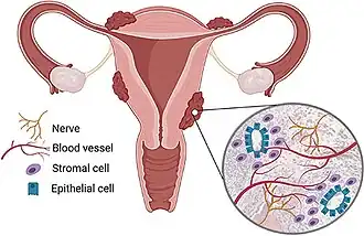 schematic showing uterus with endometriosis on the outside, and a close-up of a lesion. The closeup shows regions with epithelial cells are surrounded by stromal cells, and have an associated blood supply and nerves.