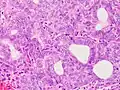 Grade 2: >5% and ≤50% solid non-glandular, non-squamous growth.[63]