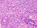 Grade 3: >50% solid non-glandular, non-squamous growth.[63]