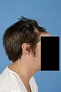 Pre-operative frontal defect