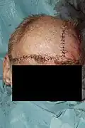 Flap rotated and wounds closed primarily