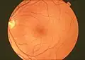 A normal human fundus