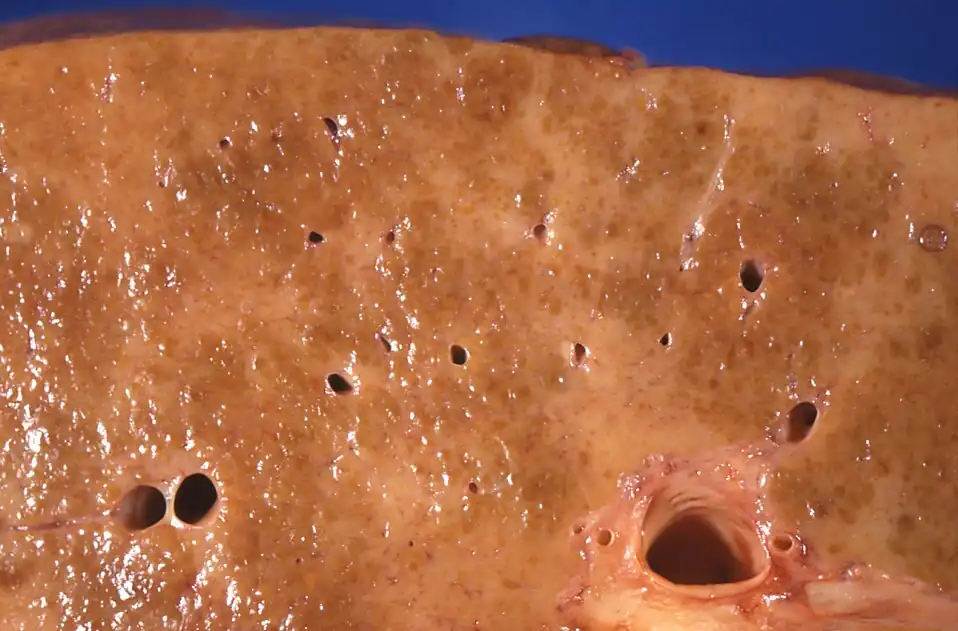 Diffuse cirrhosis