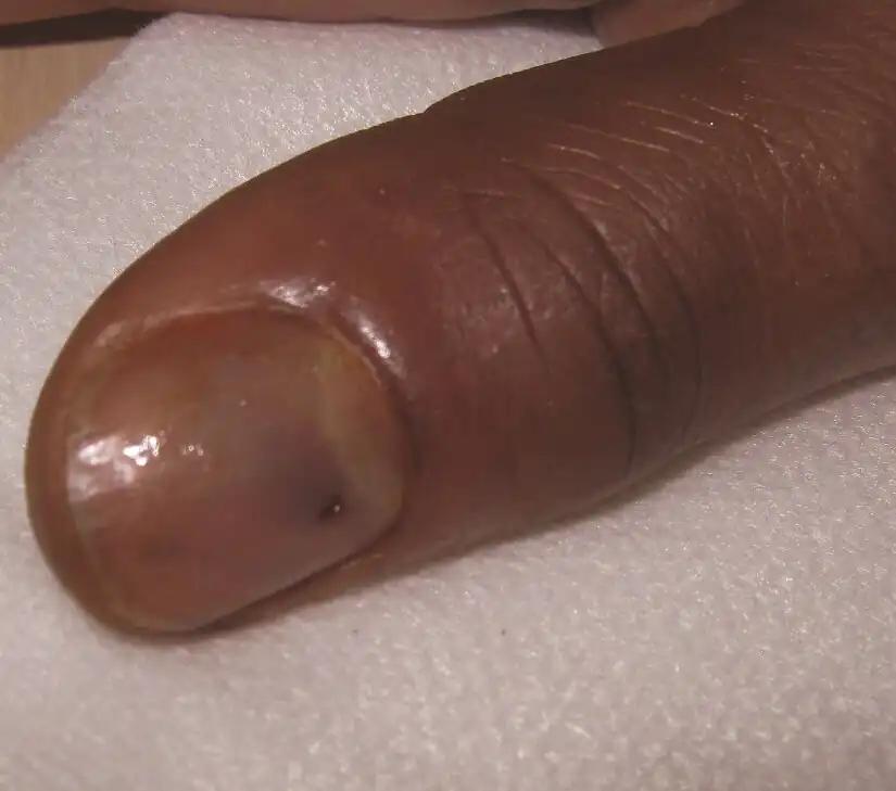 Thumbnail with small hole just above the crescent, a slight amount of blue discolouration next to the hole