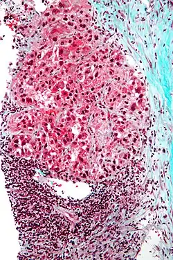 Mallory bodies in hepatocellular carcinoma. Trichrome stain.
