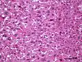 Inflammatory hepatocellular adenoma