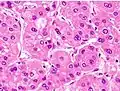 Moderately differentiated HCC