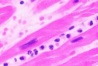 Neutrophils are seen in a myocardial infarction at approximately 12–24 hours,[70] as seen in this micrograph.