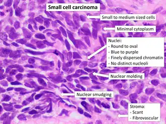 Histopathology of small-cell carcinoma, with typical findings[131]