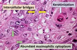 Squamous cell carcinoma with typical histopathology features